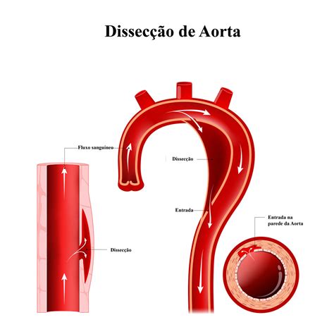dissecção da aorta